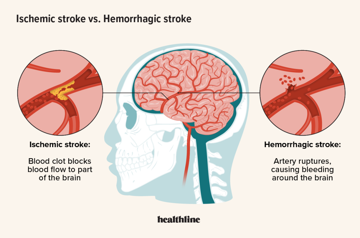 World Stroke Day: Understanding Stroke Prevention and Management