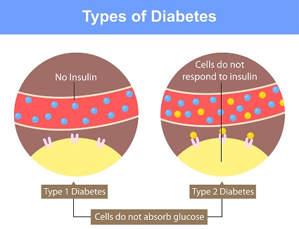 diabetes-types.jpg