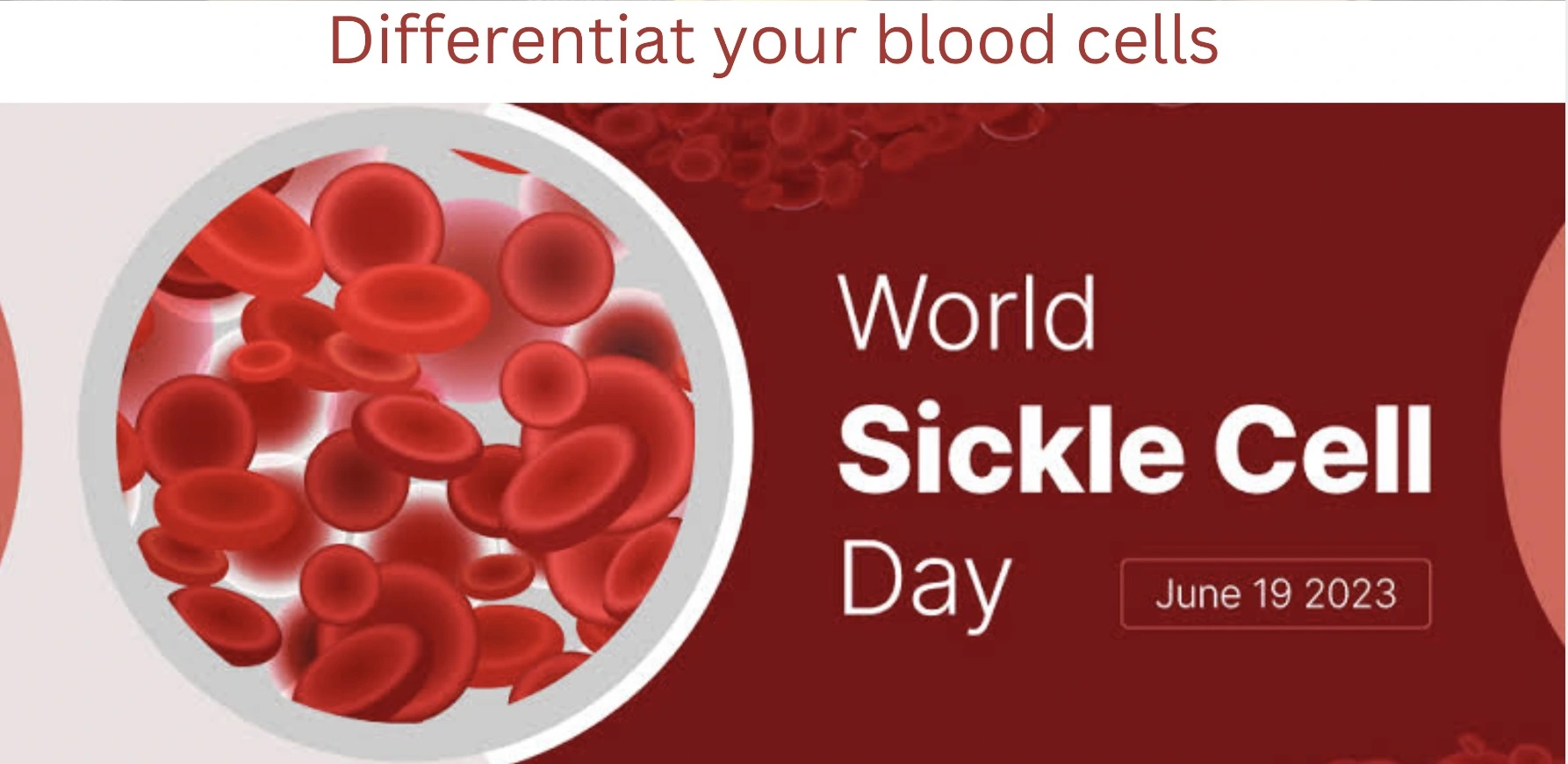 World Sickle Cell Day: Early Diagnosis Through Rapid Test Kits