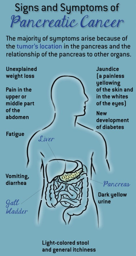 pancreatic-cancer-infographic.jpg