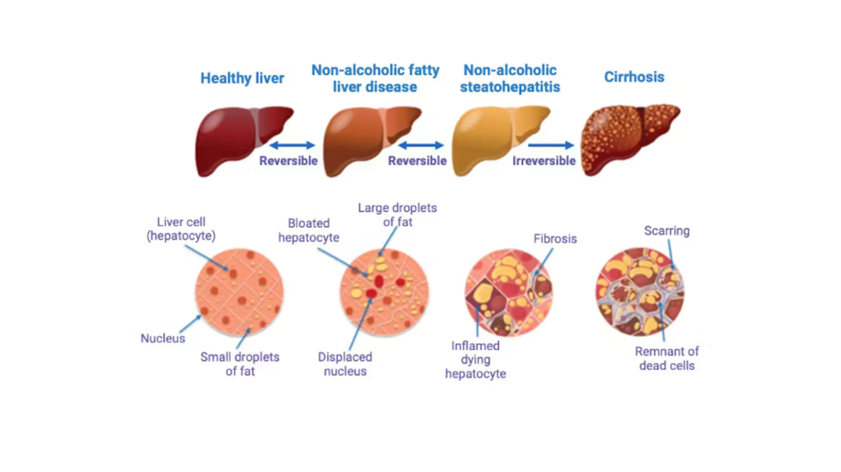 Fatty Liver:  The Leading Chronic Liver Disease in Our Country