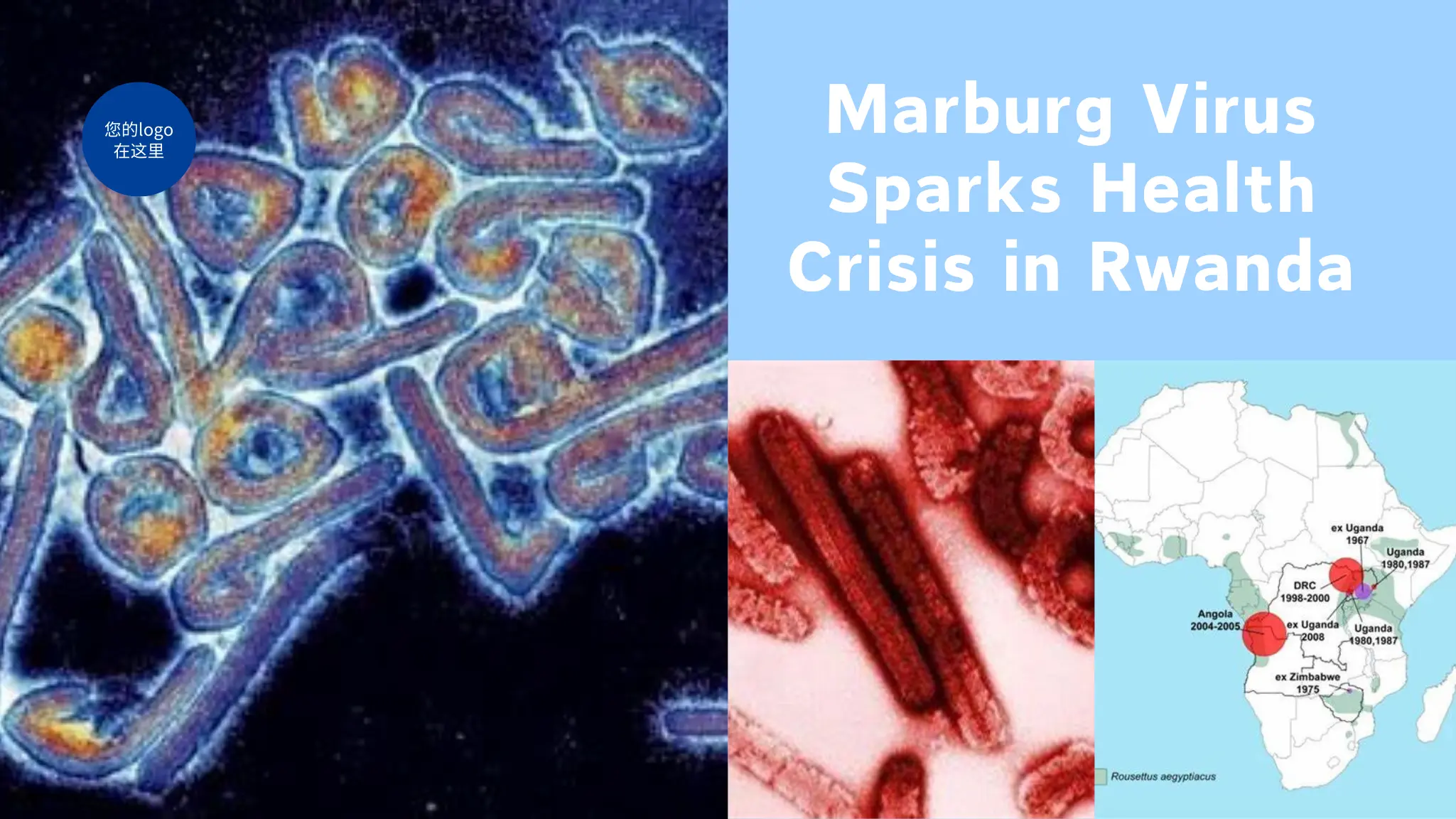 Marburg Virus Sparks Health Crisis in Rwanda