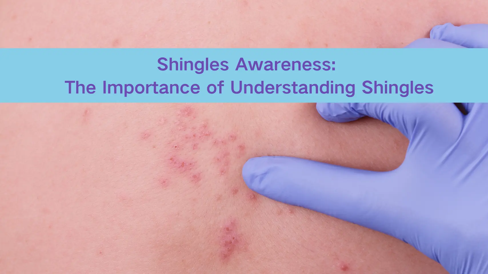 Shingles Awareness: A Recent Case Highlights the Importance of Understanding Shingles