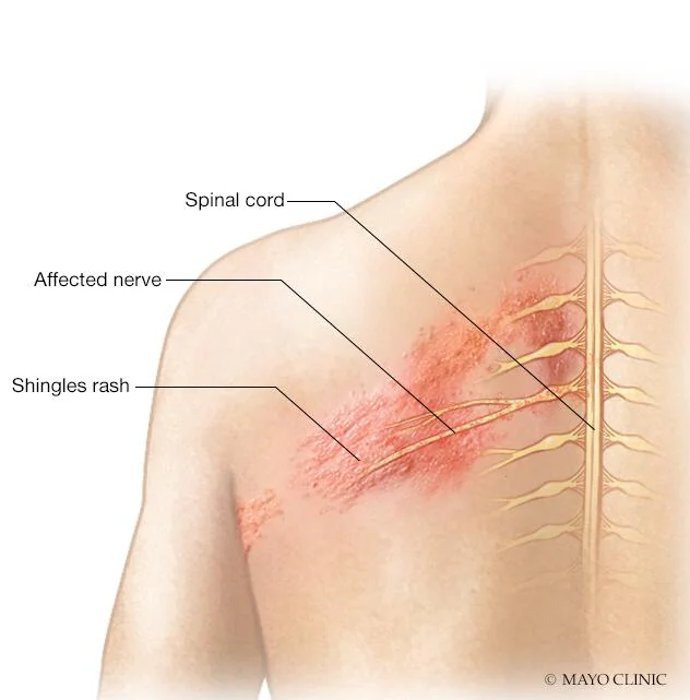 shingles-affects.webp