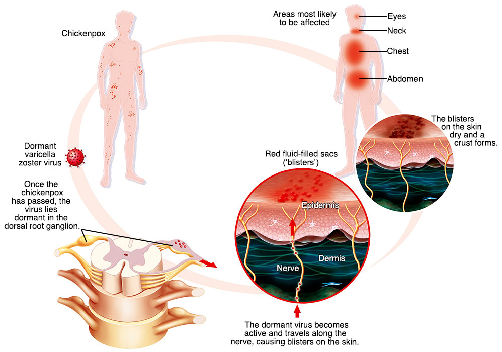 shingles-illustration-43cd4b.jpg